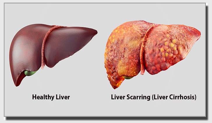 লিভার ভালো রাখতে যে কাজগুলো করা জরুরি